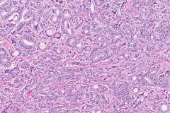 Adenocarcinoma of the prostate gland