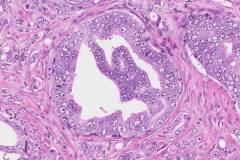 Adenocarcinoma of the prostate gland