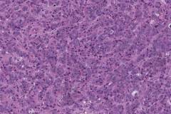 Metastatic adenocarcinoma from the prostate gland to a lymph node in the neck