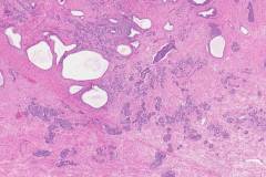 Adenocarcinoma of the prostate gland