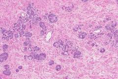 Adenocarcinoma of the prostate gland