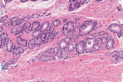 Adenocarcinoma of the prostate gland