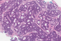 Adenocarcinoma of the prostate gland