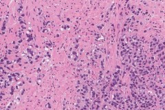 Adenocarcinoma of the prostate gland