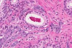 Adenocarcinoma of the prostate gland