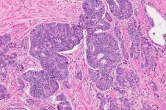 Adenocarcinoma of the prostate gland