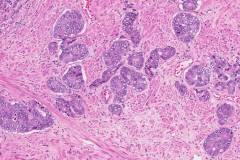 Adenocarcinoma of the prostate gland