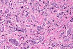 Adenocarcinoma of the prostate gland