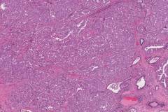 Adenocarcinoma of the prostate gland