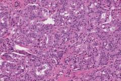 Adenocarcinoma of the prostate gland