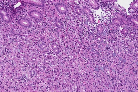 Adenocarcinoma Of The Stomach 