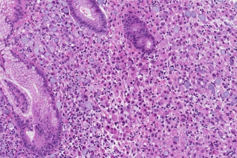 Adenocarcinoma of the stomach | Atlas of Pathology