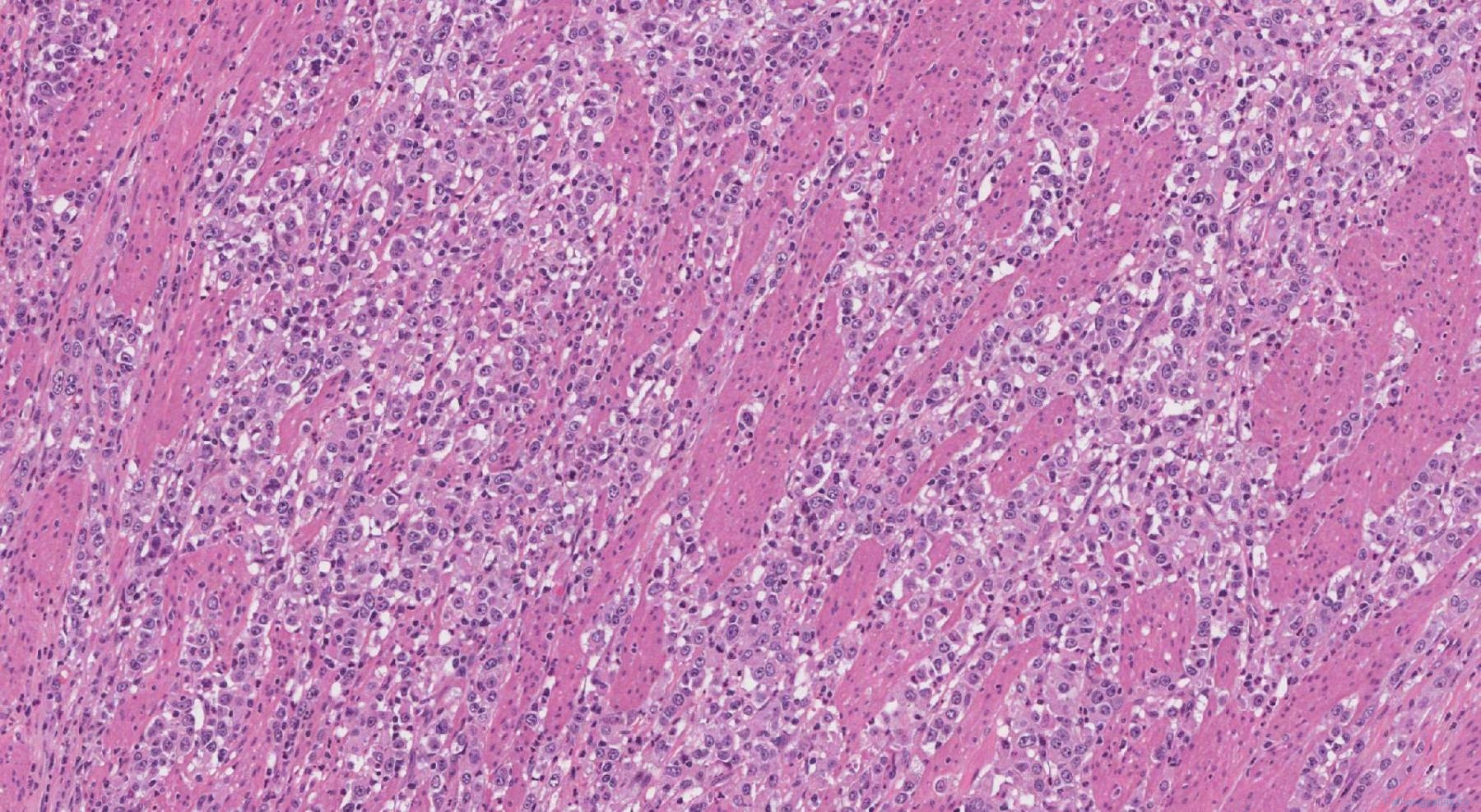 Adenocarcinoma Of The Stomach Atlas Of Pathology