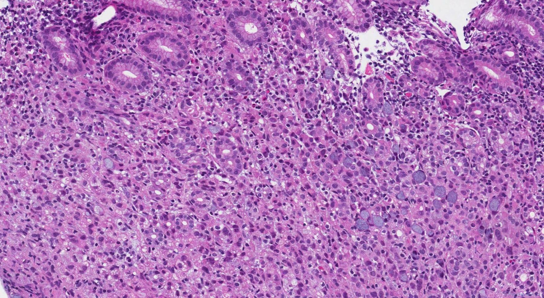 Adenocarcinoma of the stomach | Atlas of Pathology