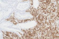 Poorly differentiated adenocarcinoma arising from a foveolar adenoma with high grade dysplasia