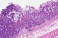 Adenocarcinoma of the stomach arising from a background of intestinal metaplasia