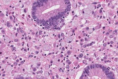 Poorly cohesive adenocarcinoma of the stomach with signet ring cells