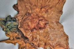 Diffuse type gastric adenocarcinoma