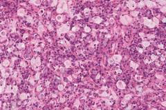 Metastatic signet ring cell type adenocarcinoma from the colon to the ovary