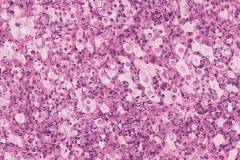 Metastatic signet ring cell type adenocarcinoma from the colon to the ovary