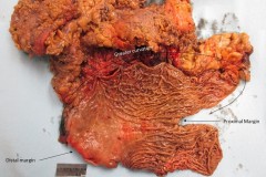 Signet ring adenocarcinoma of the stomach