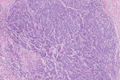 Poorly differentiated adenocarcinoma of the stomach