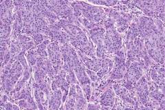 Poorly differentiated adenocarcinoma of the stomach