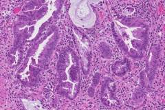 Tubular adenocarcinoma of the stomach