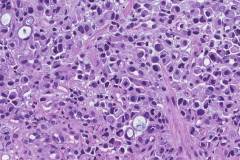 Adenocarcinoma of the stomach | Atlas of Pathology