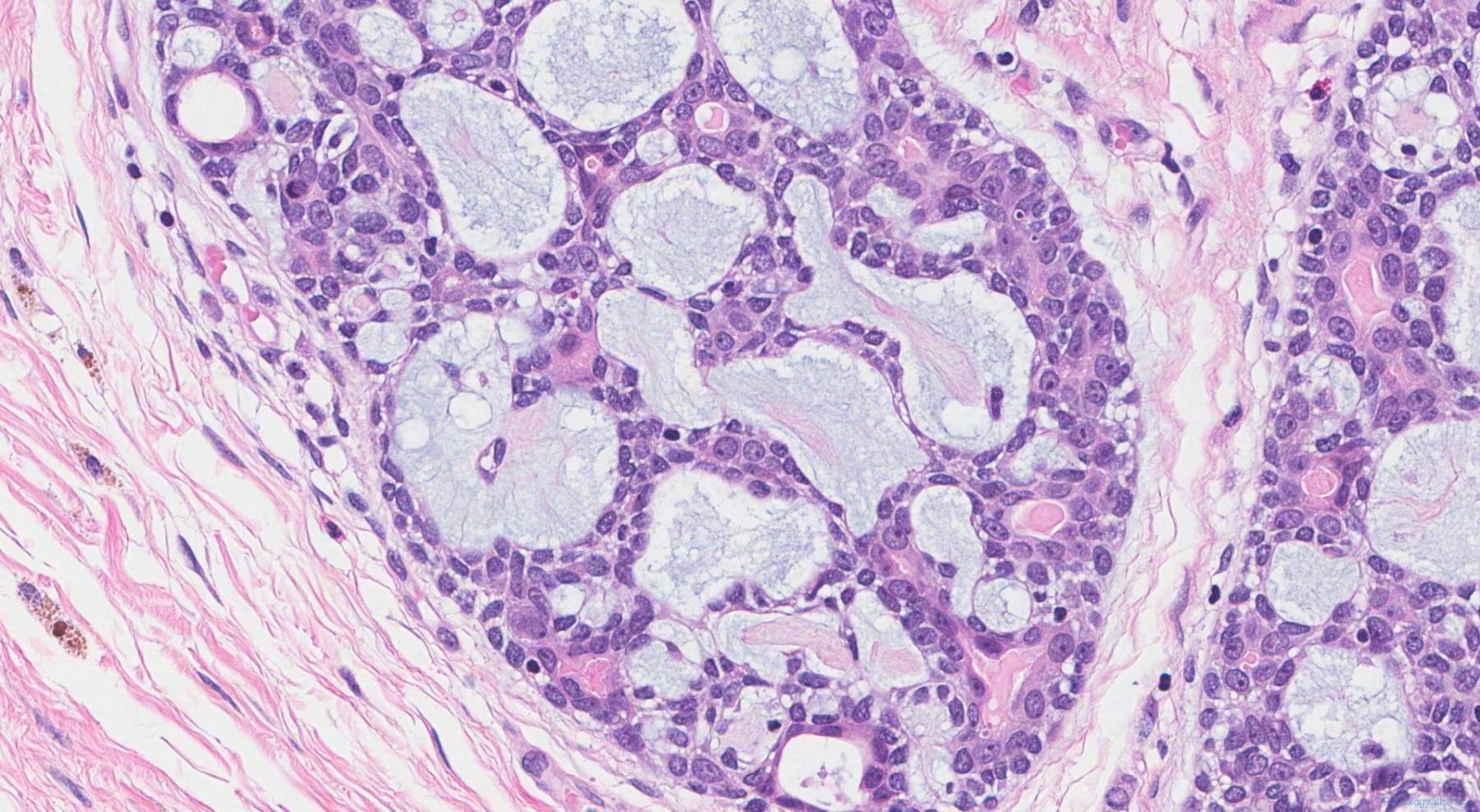 Adenoid Cystic Carcinoma Of The Breast Atlas Of Pathology