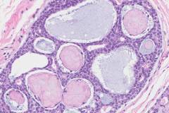 Adenoid cystic carcinoma of the breast