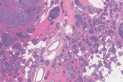 Adenoid cystic carcinoma of the breast