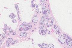 Adenoid cystic carcinoma of the breast