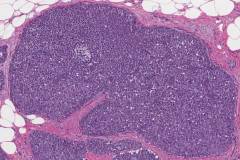 Adenoid cystic carcinoma of the breast