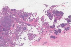 Adenoid cystic carcinoma of the breast