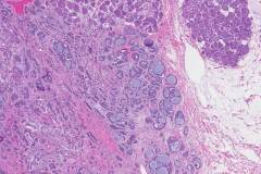 Adenoid cystic carcinoma