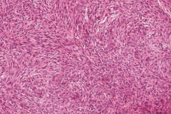 Adenomatoid odontogenic tumour