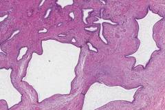 Adenomyosis of the gallbladder