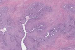 Adenosarcoma of the cervix