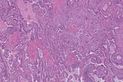 Adenosquamous carcinoma of the lung