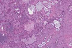 Adenosquamous carcinoma of the lung