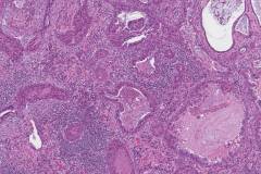 Adenosquamous carcinoma of the lung