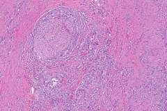 Adenosquamous carcinoma of the pancreas