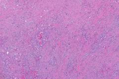 Adenosquamous carcinoma of the pancreas