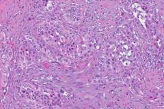 Adenosquamous carcinoma of the pancreas