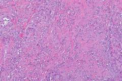 Adenosquamous carcinoma of the pancreas