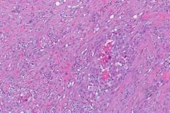 Adenosquamous carcinoma of the pancreas