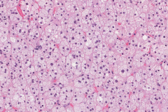 Adrenal cortical adenoma