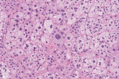 Adrenal cortical adenoma