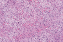 Adrenal cortical adenoma